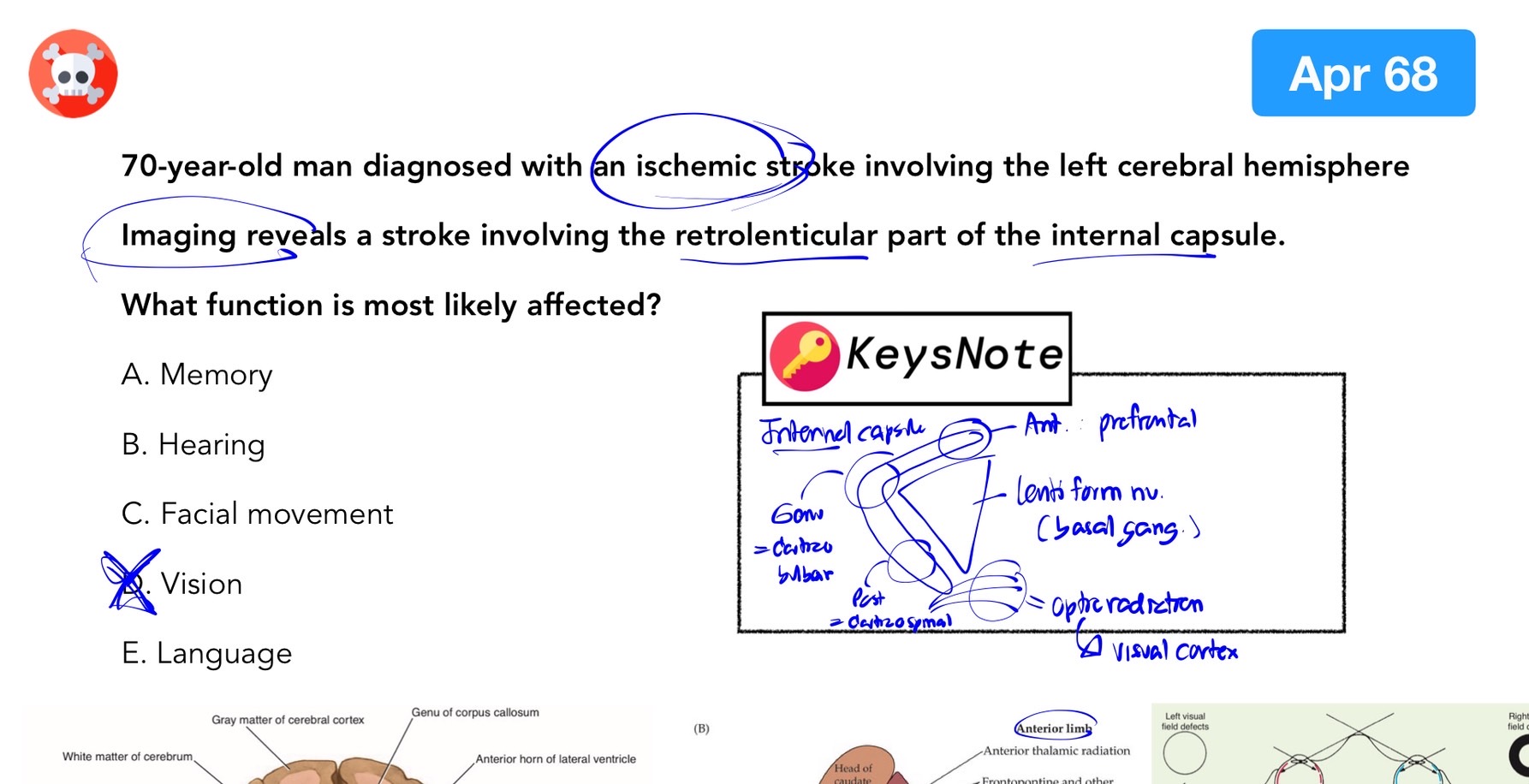 Read more about the article NL1 เมษายน 68 B3 Neurology: Ischemic Stroke กับ Visual Function