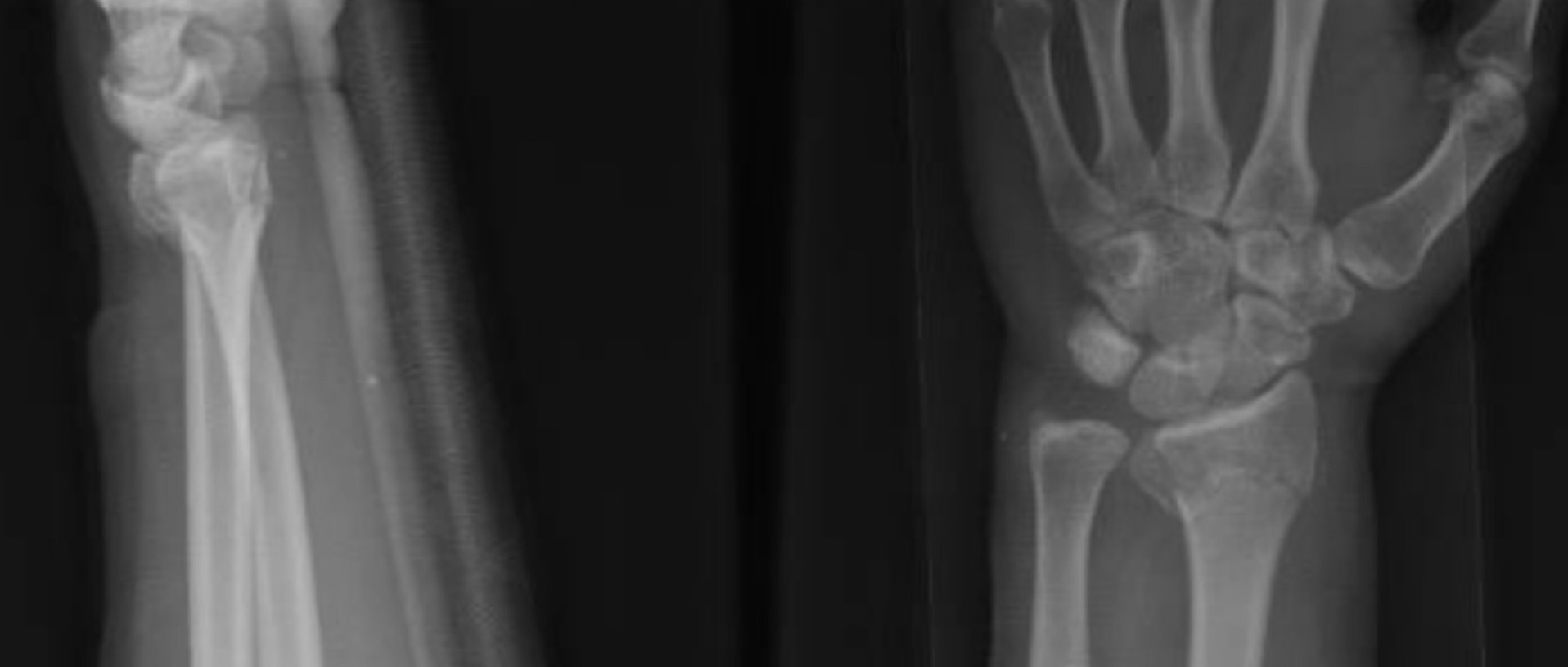 Read more about the article Colles’ fracture — เฉลยข้อสอบ MEQ มิถุนายน 2568 (แยก สิ่งที่โจทย์ให้ / คำถาม / คำตอบ ทีละหน้า + สรุปทวน)