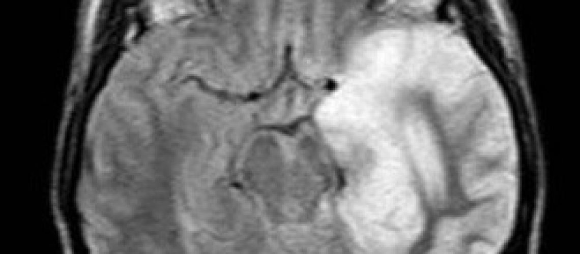Encephalitis - ข้อสอบ Comprehensive