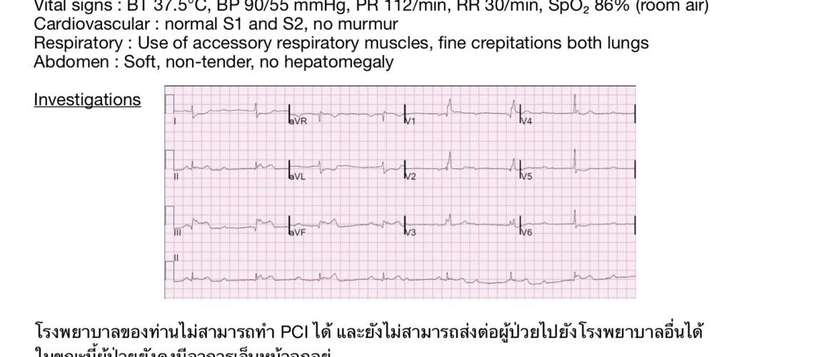 STEMI