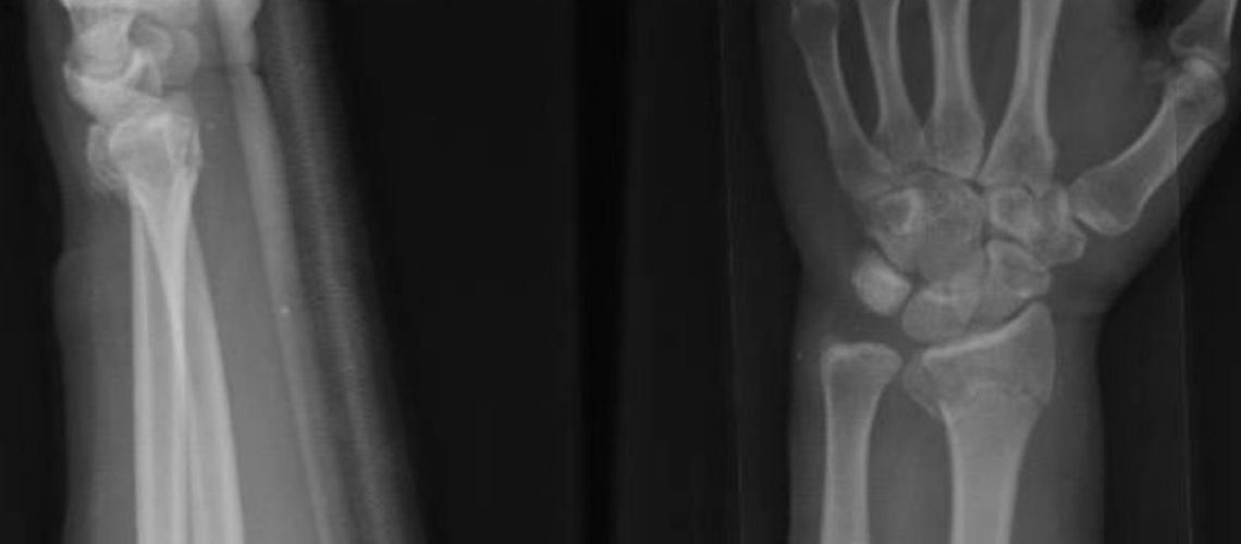 Colles’ fracture